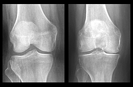 knee with osteoarthritis